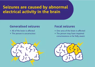 A diagram shows the difference between generalised seizures and focal seizures with explanations of each.