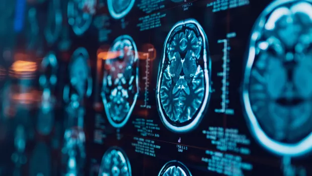 Brain scans a screen in a hospital setting